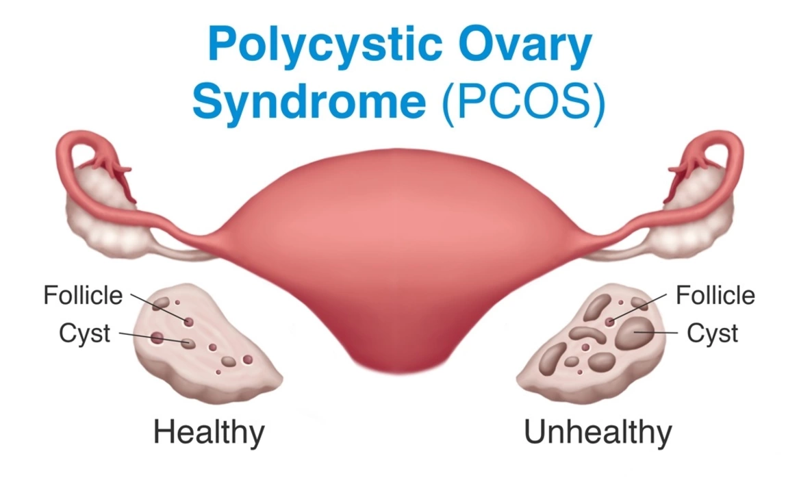 The Connection between Hirsutism and Polycystic Ovary Syndrome (PCOS)