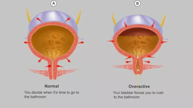 Overactive Bladder and Neurological Disorders: Understanding the Link