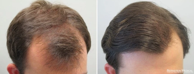 The Science Behind Minoxidilfinasteride: How It Works to Combat Hair Loss